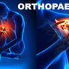 Top Orthopedic Hospitals for Joint Replacement